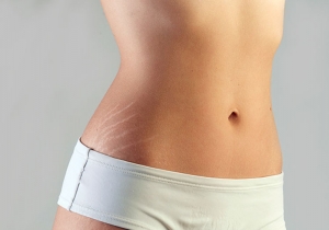 Stretch Marks Treatment in Bangalore